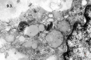 Whipple disease Whipple disease